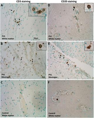 Lymphocytes Contribute to the Pathophysiology of Neonatal Brain Injury